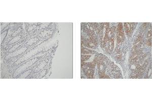 Left and Center: Immunohistochemical staining of normal colon tissue and colon carcinoma tissue using ATIC antibody . (ATIC 抗体)