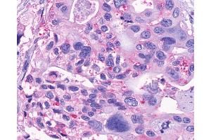 Anti-GPR150 antibody IHC of human Pancreas, Carcinoma. (GPR150 抗体  (N-Term))