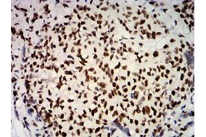 Immunohistochemical analysis of paraffin-embedded breast cancer tissues using ESR1 mouse mAb with DAB staining. (Estrogen Receptor alpha 抗体  (AA 2-185))