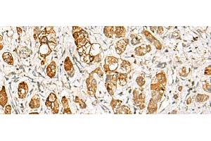 Immunohistochemistry of paraffin-embedded Human liver cancer tissue using RIMS3 Polyclonal Antibody at dilution of 1:60(x200) (RIMS3 抗体)