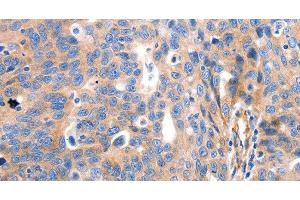 Immunohistochemistry of paraffin-embedded Human ovarian cancer tissue using IGFBP7 Polyclonal Antibody at dilution 1:50 (IGFBP7 抗体)