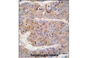 Formalin-fixed and paraffin-embedded human hepatocarcinoma tissue reacted with IRS2 antibody (C-term), which was peroxidase-conjugated to the secondary antibody, followed by DAB staining. (IRS2 抗体  (C-Term))
