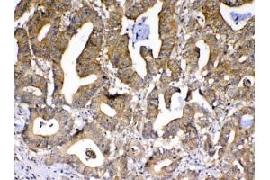 IHC testing of FFPE human rectal cancer tissue with PPID antibody at 1ug/ml. (PPID 抗体)