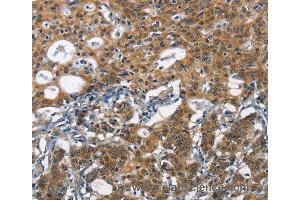 Immunohistochemistry of Human liver cancer using DCC Polyclonal Antibody at dilution of 1:70 (DCC 抗体)