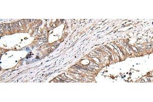 Immunohistochemistry of paraffin-embedded Human colorectal cancer tissue using ZNHIT1 Polyclonal Antibody at dilution of 1:40(x200) (ZNHIT1 抗体)