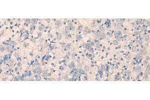 Immunohistochemistry of paraffin-embedded Human cervical cancer tissue using FAM91A1 Polyclonal Antibody at dilution of 1:35(x200) (FAM91A1 抗体)