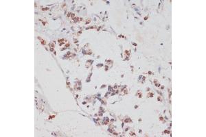 Immunohistochemistry of paraffin-embedded human gastric cancer using HT antibody (ABIN7267756) at dilution of 1:100 (40x lens). (HTATSF1 抗体  (AA 1-180))