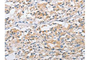 The image on the left is immunohistochemistry of paraffin-embedded Human thyroid cancer tissue using ABIN7128506(ARHGEF9 Antibody) at dilution 1/50, on the right is treated with fusion protein. (Arhgef9 抗体)