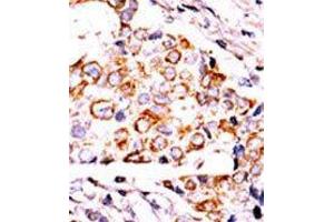 Formalin-fixed and paraffin-embedded human cancer tissue reacted with the primary antibody, which was peroxidase-conjugated to the secondary antibody, followed by DAB staining. (NME3 抗体  (AA 59-88))