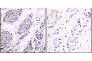 Immunohistochemistry analysis of paraffin-embedded human breast carcinoma tissue, using TGF beta3 Antibody. (TGFB3 抗体  (AA 261-310))