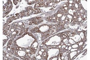 IHC-P Image Immunohistochemical analysis of paraffin-embedded gastric cancer N87 xenograft, using AK3L1, antibody at 1:100 dilution. (AK4 抗体)