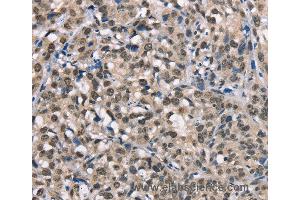 Immunohistochemistry of Human esophagus cancer using NDNL2 Polyclonal Antibody at dilution of 1:40 (Necdin-Like 2 抗体)