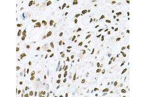Immunohistochemistry of paraffin-embedded Human lung cancer using JNK1 Polyclonal Antibody at dilution of 1:100 (40x lens). (JNK 抗体)