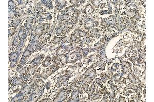 MCM2 Mouse Monoclonal Antibody at 1/100 staining human colorectal cancer by IHC-P. (MCM2 抗体)
