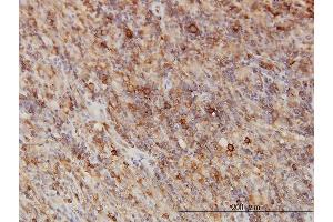 Immunoperoxidase of monoclonal antibody to G3BP on formalin-fixed paraffin-embedded human lymphoma. (G3BP1 抗体  (AA 214-303))