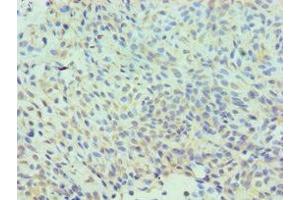 Immunohistochemistry of paraffin-embedded human breast cancer using ABIN7147585 at dilution of 1:100 (CLIC1 抗体  (AA 42-241))
