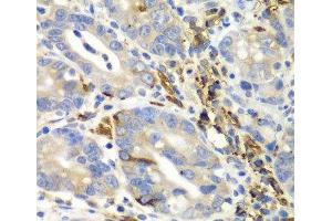 Immunohistochemistry of paraffin-embedded Human gastric cancer using AIMP1 Polyclonal Antibody at dilution of 1:100 (40x lens). (AIMP1 抗体)