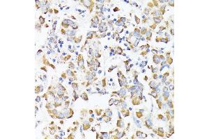 Immunohistochemistry of paraffin-embedded human liver cancer using RHOG antibody (ABIN7269864) at dilution of 1:100 (40x lens). (RHOG 抗体)