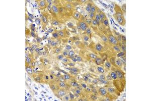 Immunohistochemistry of paraffin-embedded human esophageal cancer using AK1 antibody. (Adenylate Kinase 1 抗体)