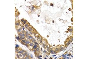 Immunohistochemistry of paraffin-embedded human stomach cancer using GYS1 antibody. (Glycogen Synthase 1 抗体  (AA 488-737))