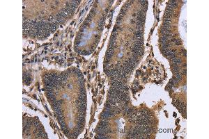 Immunohistochemistry of Human colon cancer using DCP1A Polyclonal Antibody at dilution of 1:50 (DCP1A 抗体)