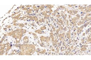 Detection of RRM1 in Human Breast cancer Tissue using Polyclonal Antibody to Ribonucleotide Reductase M1 (RRM1)