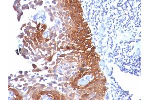 Formalin-fixed, paraffin-embedded human Cervical Ca stained with Cytokeratin 18 Mouse Monoclonal Antibody (Cocktail).