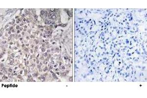 Immunohistochemistry analysis of paraffin-embedded human liver carcinoma tissue using CYP4F2 polyclonal antibody . (CYP4F2 抗体)