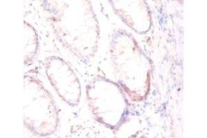 Immunohistochemistry of paraffin-embedded human colon cancer using ABIN7153948 at dilution of 1:50 (PSMA 抗体  (AA 48-750))