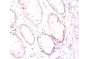Immunohistochemistry of paraffin-embedded human colon cancer using ABIN7153948 at dilution of 1:50 (PSMA 抗体  (AA 48-750))
