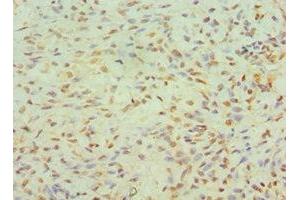 Immunohistochemistry of paraffin-embedded human breast cancer using ABIN7145557 at dilution of 1:100 (JMJD6 抗体  (AA 1-320))