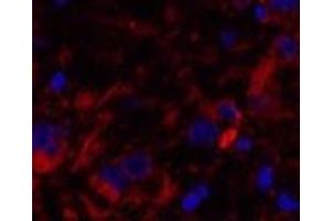 Immunofluorescence analysis of Human breast cancer tissue using Cleaved-CASP8 (D384) Polyclonal Antibody at dilution of 1:200. (Caspase 8 抗体  (Cleaved-Asp384))