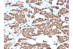 Formalin-fixed, paraffin-embedded human Breast Carcinoma stained with Histone H1 Rabbit Recombinant Monoclonal Antibody (AE-4). (Recombinant Histone H1 抗体)