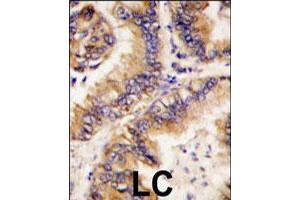 Formalin-fixed and paraffin-embedded human lung carcinoma tissue reacted with TRAPPC4 polyclonal antibody  , which was peroxidase-conjugated to the secondary antibody, followed by DAB staining. (TRAPPC4 抗体  (N-Term))
