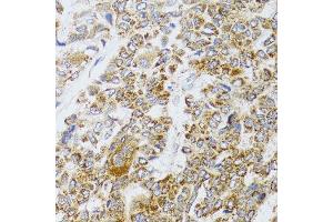 Immunohistochemistry of paraffin-embedded human liver cancer using AIFM3 antibody (ABIN5996156) at dilution of 1/100 (40x lens). (AIFM3 抗体)