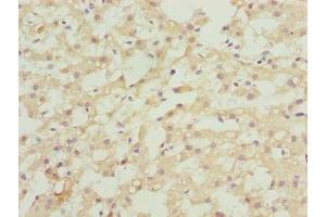 Immunohistochemistry of paraffin-embedded human liver cancer using ABIN7144572 at dilution of 1:100 (ASAP3 抗体  (AA 451-700))