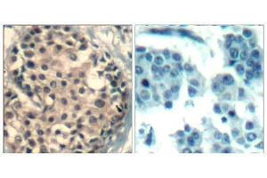 Immunohistochemical analysis of paraffin-embedded human breast carcinoma tissue using HDAC4/HDAC5/ HDAC9 (phospho-Ser246/259/220) Antibody (E011517). (HDAC4/HDAC5/HDAC9 抗体  (pSer220, pSer246, pSer259))