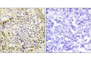 Immunohistochemistry analysis of paraffin-embedded human lung carcinoma tissue, using IRX2 Antibody. (IRX2 抗体  (AA 231-280))