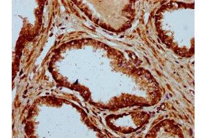 IHC image of ABIN7150052 diluted at 1:500 and staining in paraffin-embedded human prostate cancer performed on a Leica BondTM system. (ADAM29 抗体  (AA 701-820))