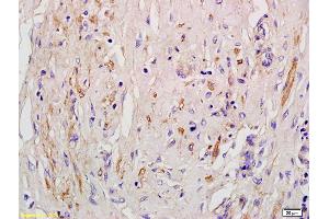 Formalin-fixed and paraffin embedded human pneumonic lung tissue labeled with Anti-EDG4/LPA2 Polyclonal Antibody, Unconjugated (ABIN681118) at 1:200 followed by conjugation to the secondary antibody and DAB staining