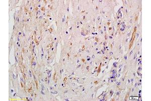 Formalin-fixed and paraffin embedded human pneumonic lung tissue labeled with Anti-EDG4/LPA2 Polyclonal Antibody, Unconjugated (ABIN681118) at 1:200 followed by conjugation to the secondary antibody and DAB staining (Angiotensin II Type-1 Receptor 抗体)