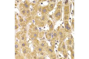 Immunohistochemistry of paraffin-embedded human liver damage using Slug Antibody (ABIN6127298, ABIN6148181, ABIN6148183 and ABIN6217314) at dilution of 1:100 (40x lens). (SLUG 抗体  (AA 126-268))