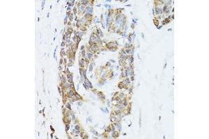 Immunohistochemistry of paraffin-embedded human esophageal cancer using TOLLIP antibody (ABIN5971228) at dilution of 1/100 (40x lens). (TOLLIP 抗体)