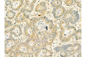 SPTBN1 Mouse Monoclonal Antibody at 1/100 staining human colorectal cancer by IHC-P. (SPTBN1 抗体  (N-Term))