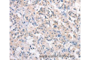 Immunohistochemistry of Human thyroid cancer using CRHR2 Polyclonal Antibody at dilution of 1:25 (CRHR2 抗体)