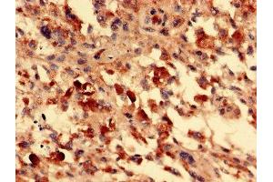Immunohistochemistry analysis of human melanoma using ABIN7153105 at dilution of 1:100 (FOXR2 抗体  (AA 1-300))