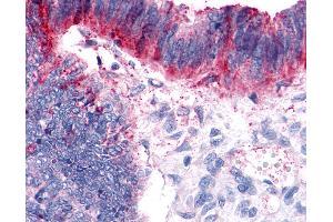 Anti-GPER1 / GPR30 antibody IHC of human Colon, Carcinoma.