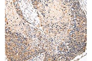 The image on the left is immunohistochemistry of paraffin-embedded Human esophagus cancer tissue using ABIN7131583(VPS37A Antibody) at dilution 1/20, on the right is treated with fusion protein. (VPS37A 抗体)
