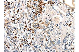 The image on the left is immunohistochemistry of paraffin-embedded Human gastric cancer tissue using ABIN7190149(CD93 Antibody) at dilution 1/60, on the right is treated with synthetic peptide. (CD93 抗体)