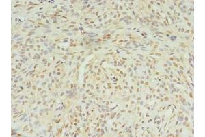 Immunohistochemistry of paraffin-embedded human breast cancer using ABIN7169003 at dilution of 1:100 (STK38L 抗体  (AA 212-464))